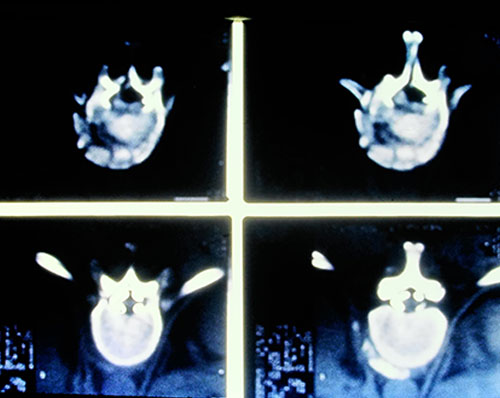 CAT Scan of spine showing badly fractured vertebra