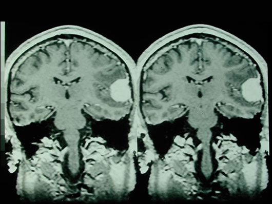 MRI Scan of Brain showing a large tumour as an area of solid white structure