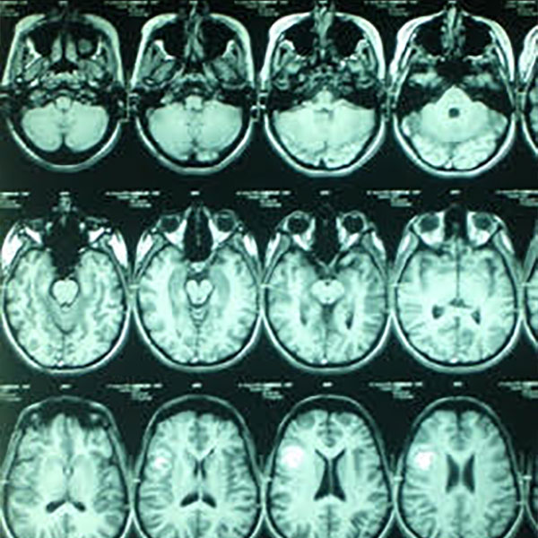 A Montage of Brain MRI pictures